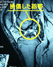 前十字靭帯再建術 Acl Ekc