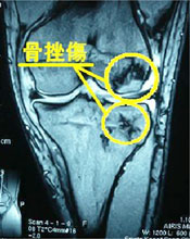 前十字靭帯再建術 Acl Ekc