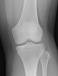 正常な膝関節（20代女性）