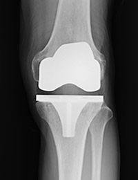 全人工膝関節置換術について：ekc