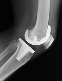 全人工膝関節置換術