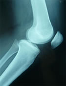 正常な膝関節（側面像）